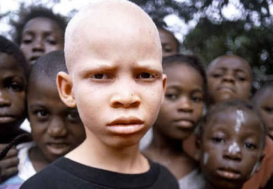Kara Kıtanın Beyaz İncileri: Afrika’da Albino Olmak